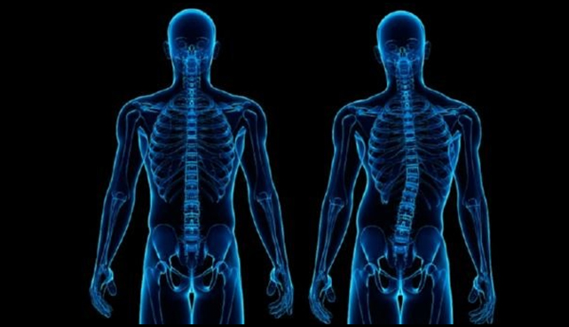 kuva skolioosin aioheuttamasta vinosta selkärangasta